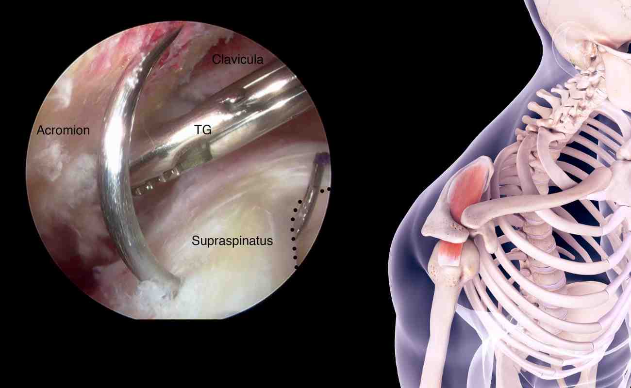 Supraspinatus tear - Curezone Physiotherapy