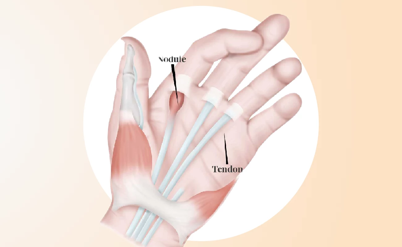Trigger Finger Physiotherapy & Hand Exercises