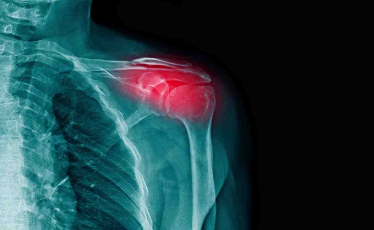 Adhesive Capsulitis - Curezone Physiotherapy