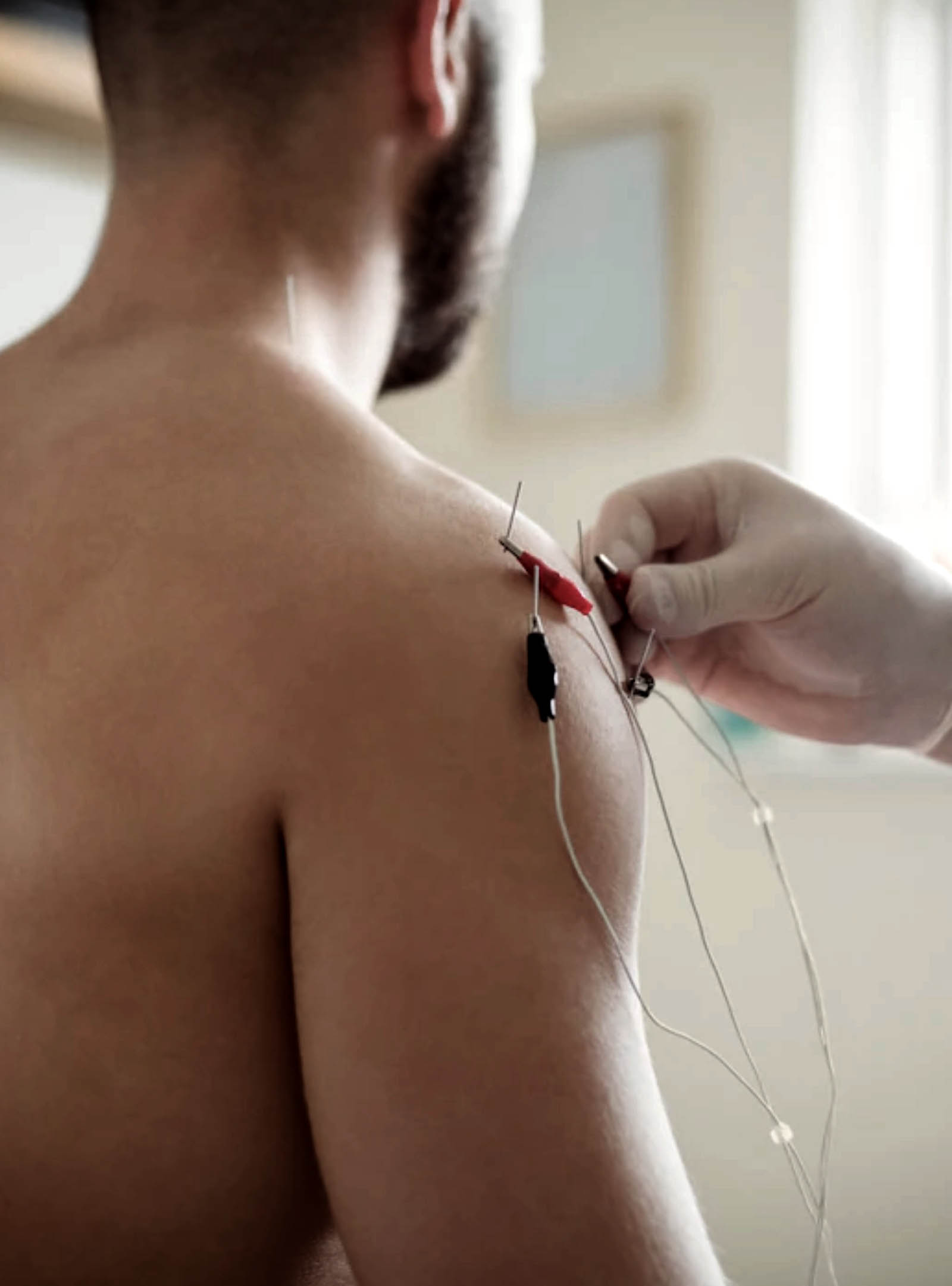 Shock Wave Therapy in Mississauga